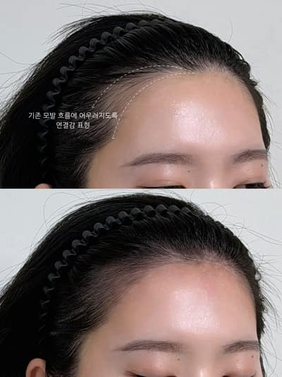 [서울 용산구] M자커버 헤어라인